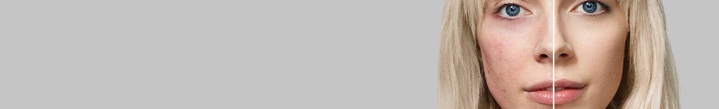 Best Makeup for Acne