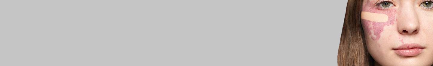 Face Birthmark Cover Up